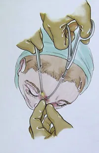 illustration of Brow Lift - endoscopic technique, Richmond VA