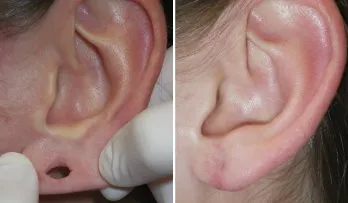 gauged earlobe repair in richmond