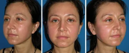 This patient is shown 1 week after cheek implants, eyelid tuck and chemical face peel