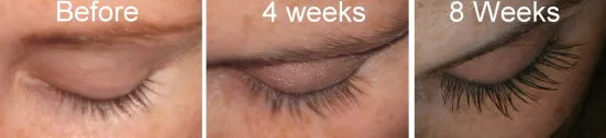 Melissa Chase at 4 and 8 weeks on Latisse