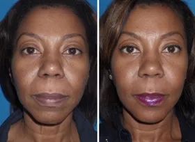 These patients underwent cheek implants and chin implants
