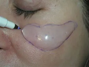 Photo closeup of Submalar Implant, Cheek Implant