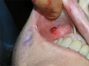 Photo of small incision for Cheek Implant