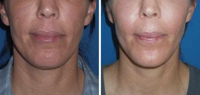 chin-implant-case-1a