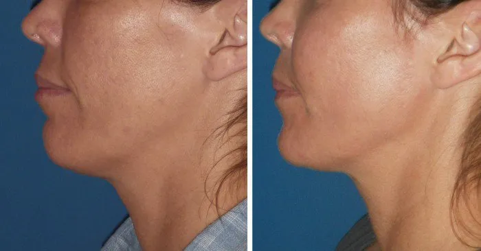 chin-implant-case-1b
