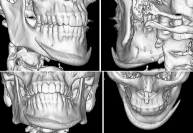 Chin & Lower Facial Implants