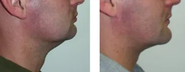 Chin implant is not always the best option. This case should have had a lengthening genioplasty to augment the chin