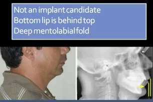Not a chin implant candididate. Bottom lip is behind the top deep mentolabialfold.