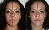 chin asymmetry, jaw asymmetry, chin surgery, Richmond VA