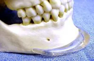 ImplanTech Silicone Chin Implant, Richmond VA