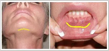 Chin implants can be placed from an incision inside the mouth for a completely hidden scar. They can also be placed through the skin under the jaw using a small incision. This images illustrates both incision approaches.