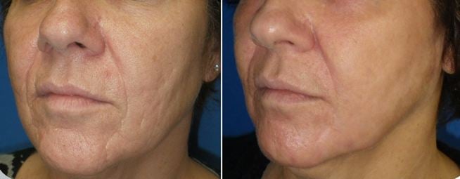 Before and after a single  laser treatment for acne.