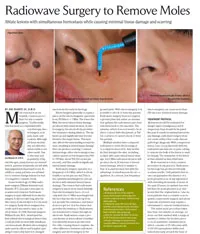 Article: Radiowave Surgery to Remove Moles Dr Dr. Niamtu Richmond VA
