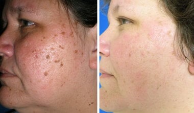 mole removal before photo