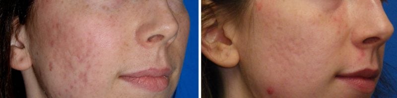 Healing after Deep FX laser resurfacing treating acne scars