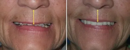 Lip Lift in Richmond, VA