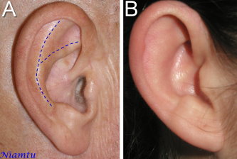 Photos of ears showing the antihelical fold, an area which is underdeveloped (left image) causing the ear to protrude