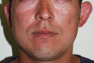 This patient has a left ear without a developed antihelical fold, making it protrude