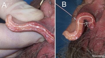 This photo taken from a cadaver dissection shows how the specialized sutures fold the ear back
