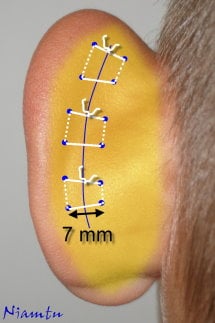 an artistic representation drawn by Dr Niamtu illustrating placement of the specialized sutures on the back surface of the ear under the skin