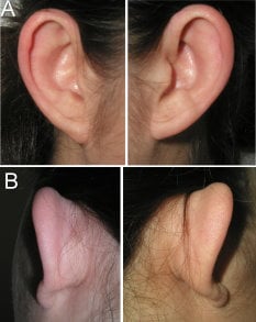 photo showing the most common causes for protruding ears