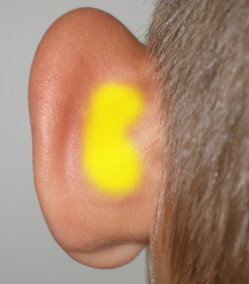 the Davis procedure treats the source of protruding ears by removing a small 'kidney bean' shaped wedge of excess cartilage