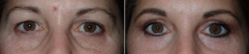 Before and after lower eyelid surgery