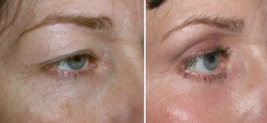 Eyelid Surgery in Richmond, VA