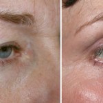 Eyelid Surgery in Richmond, VA