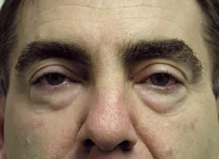 Fat protrusion of lower eyelids