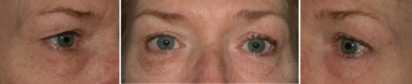 up close photo of upper face