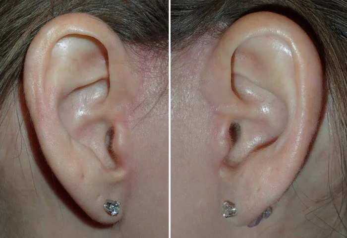 facelift scars