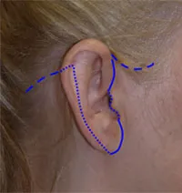 Illustration of facelift incision to preserve the hairline. Richmond VA