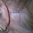 Facelift problem with a stepped hairline. Dr. Niamtu of Richmond VA can correct this problem.