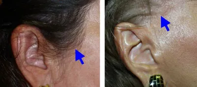 Photos of hairline problem from a facelift, and a contrasting photo with the correct hairline. Dr. Niamtu of Richmond VA can correct or improve this problem.