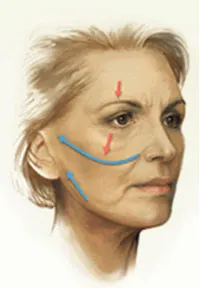 Arrows showing the  natural direction skin must be pulled in so the results after a facelift will look natural
