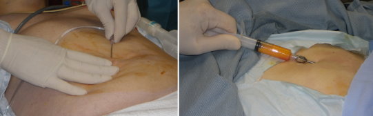 fat transfer