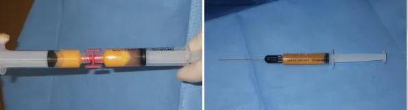 fat transfer