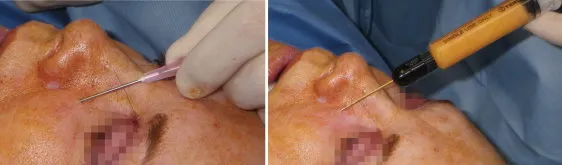 fat transfer
