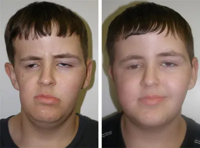 Patient with a facial growth defect was treated with fat injection. Before and after photos, Richmond VA