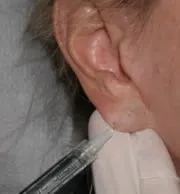 lower face fillers in richmond