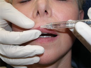 Filler injection to plump the lips, Richmond VA