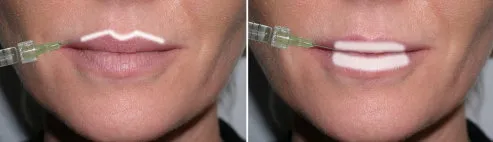 The 2 most common areas of the lips to be enhanced