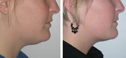 fat accumulation under patient's chin that was treated with liposuction