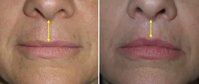 Lip Lift in Richmond, VA