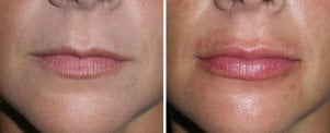 Before and after pictures lip fillers