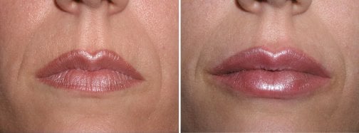 Before and after lip augmentation