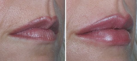 Before and after lip augmentation Richmond VA