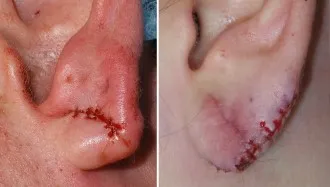 gauged earlobe repair
