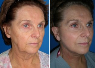 Video Testimonial for Richmond, VA Cosmetic Facial Surgery